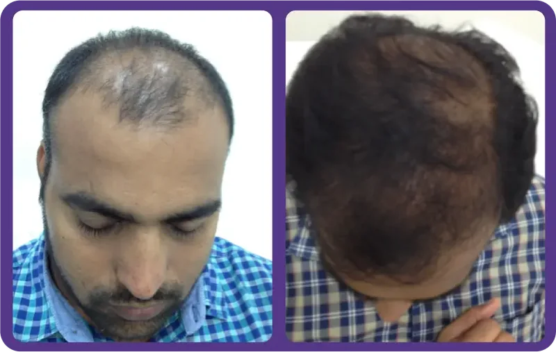 Hairfall Treatment