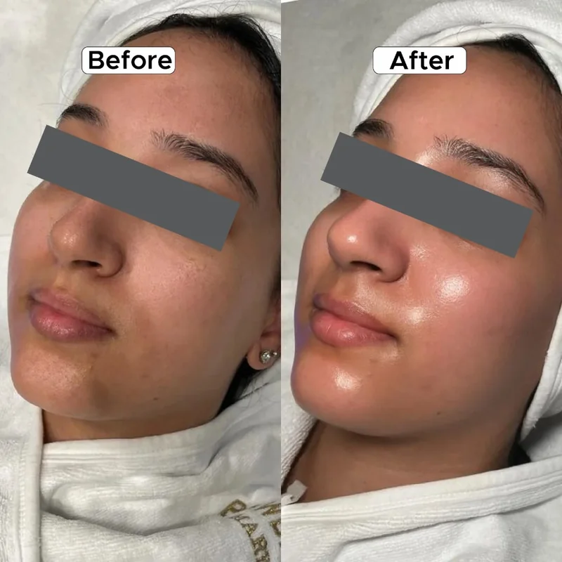 HydraFacial Before & After