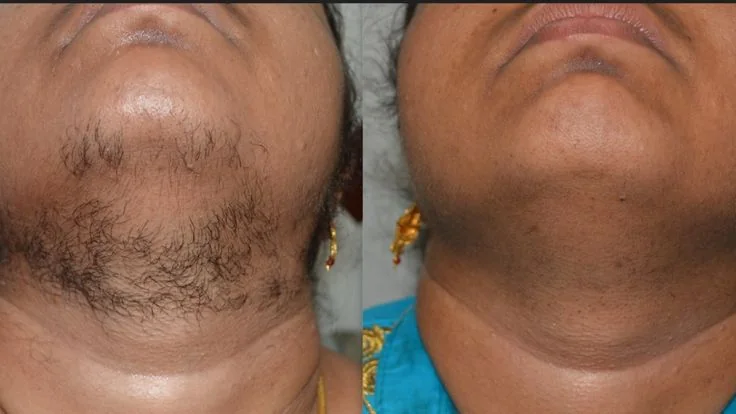Hairfall Treatment Before & After
