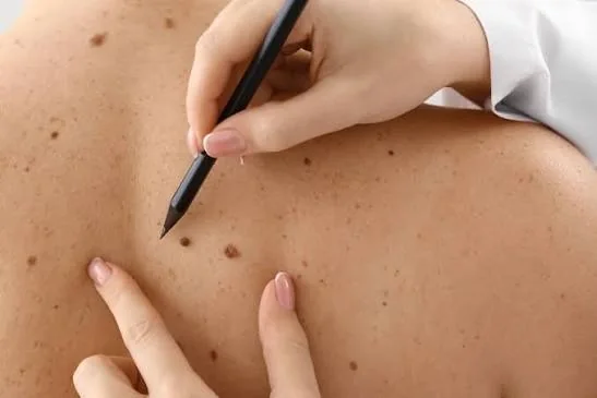 Wart & Skin Tag Removal